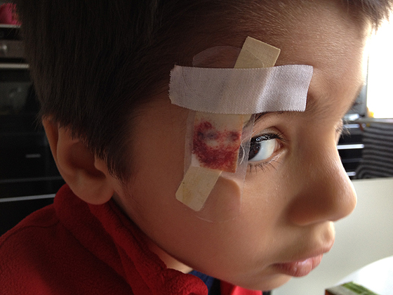 A ferida ficou bem feia, ali ao lado do olho direito, vamos ver se deixa cicatriz...